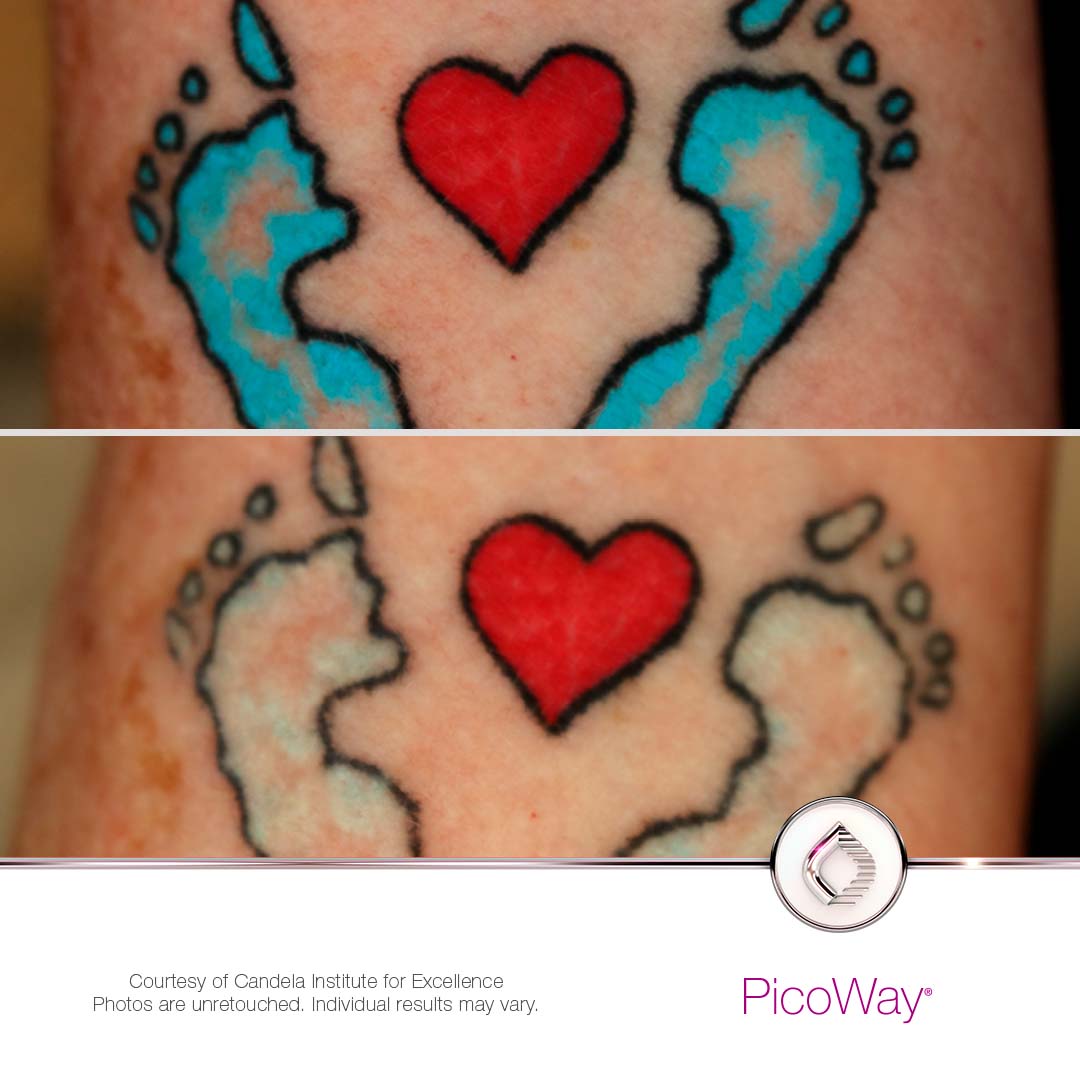 Pico Laser Tattooentfernung bei AS Medical Aesthetics Warendorf